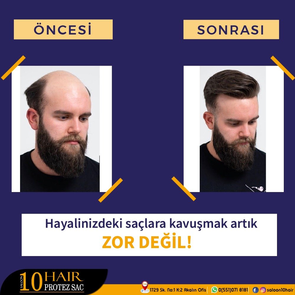 10 Hair Protez Sac Izmir Karsiyaka Firmadan